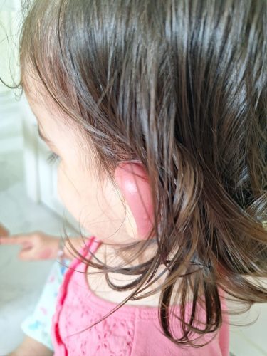 A child's ear bright red and swollen, from a mosquito bite