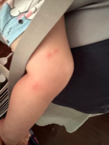A child's mosquito bite on her legs, the bite is quite mild